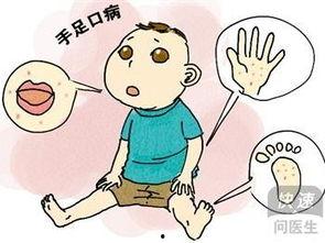 手足口病吃瓜,手足口病防控攻略